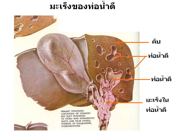 cholangiocarcinoma