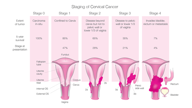 stages of cervical cancer